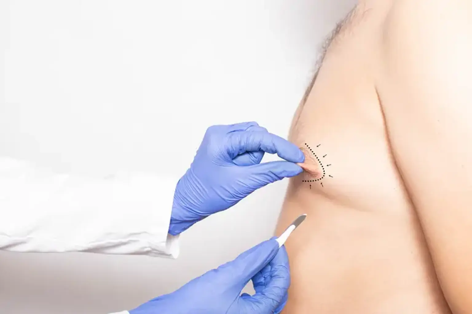 Areola Reduction