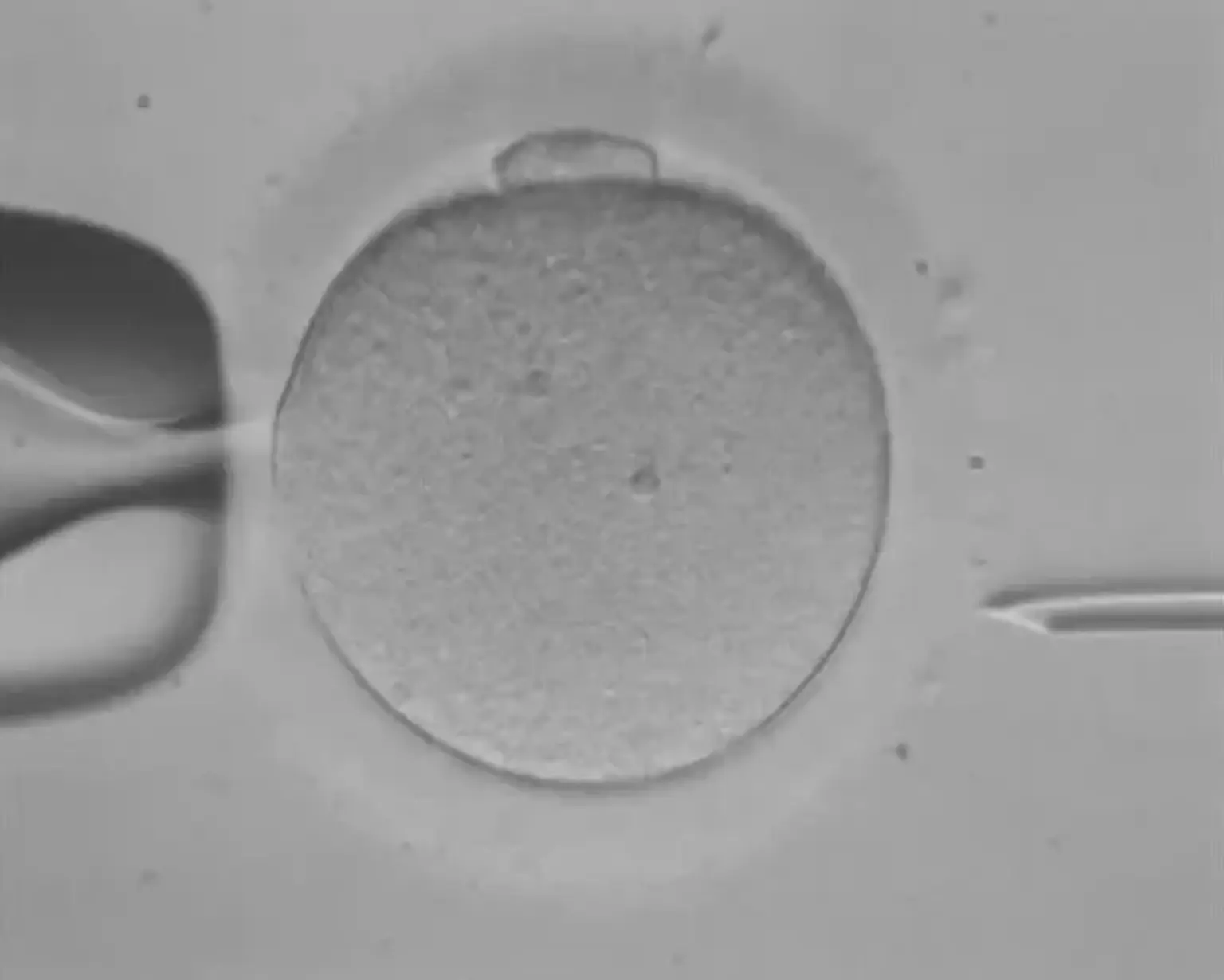 In-Vitro Fertilization (IVF) definition