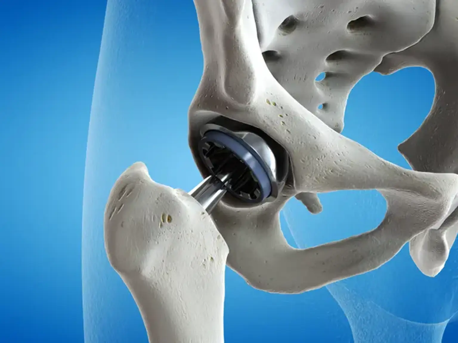 Hip Resurfacing Arthroplasty