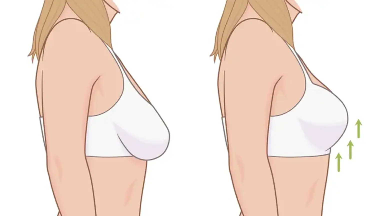 Breast Lifting