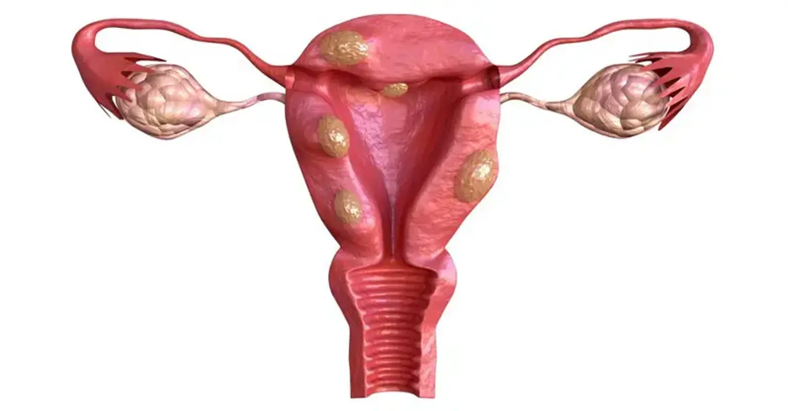 Fibroids and Infertility