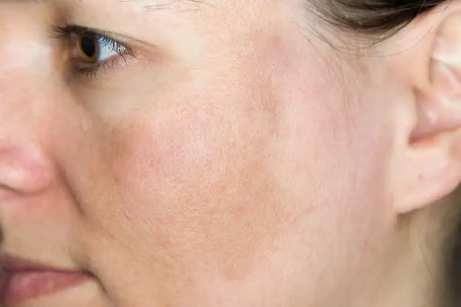 Melasma (Chloasma) Treatment
