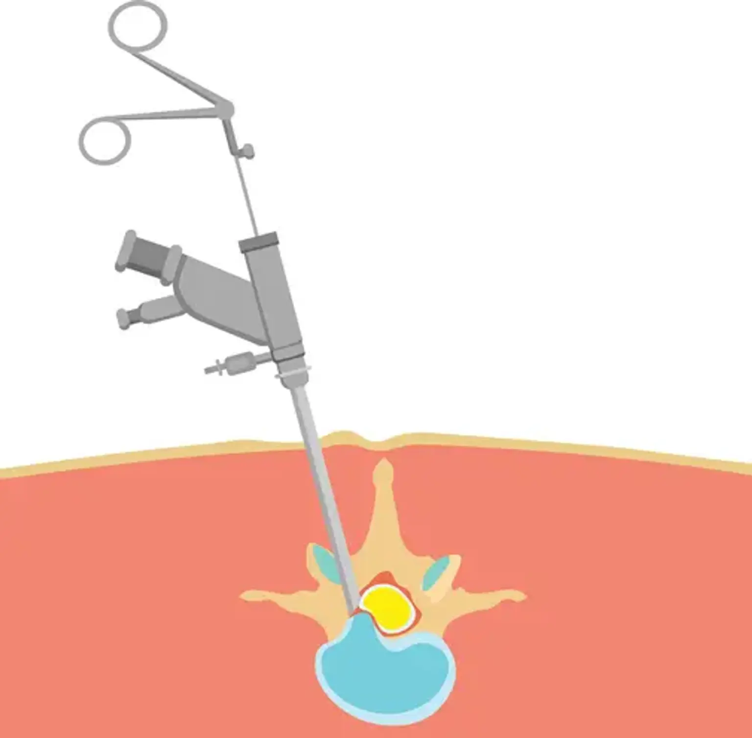 Percutaneous epidural Neuroplasty Definition