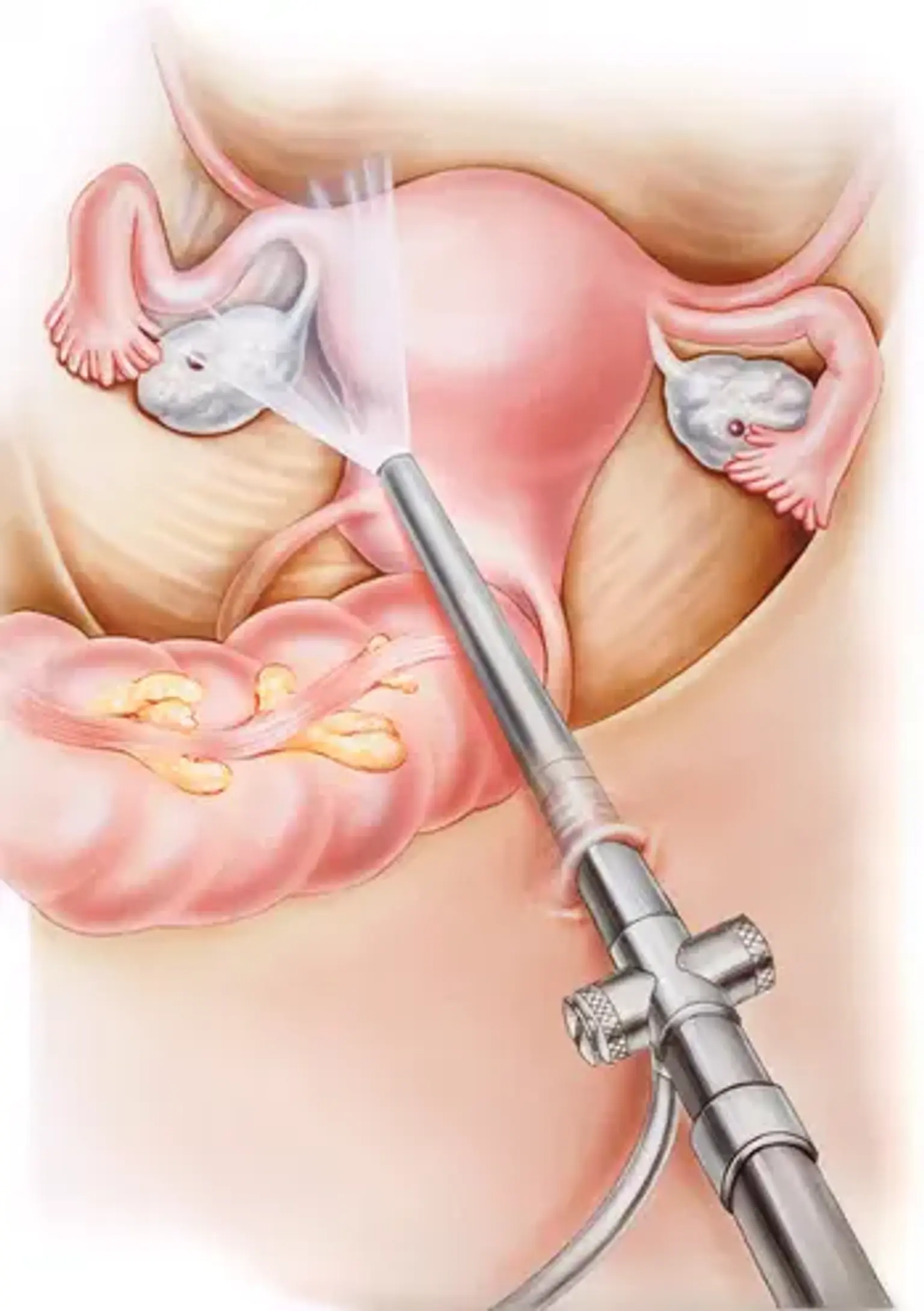 Types of Gynaecological Endoscopy