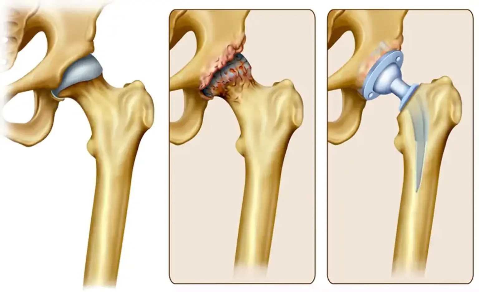 Complicated Joint Replacement
