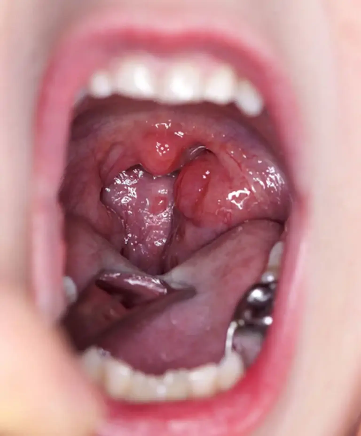 Enlarged Adenoid Treatment