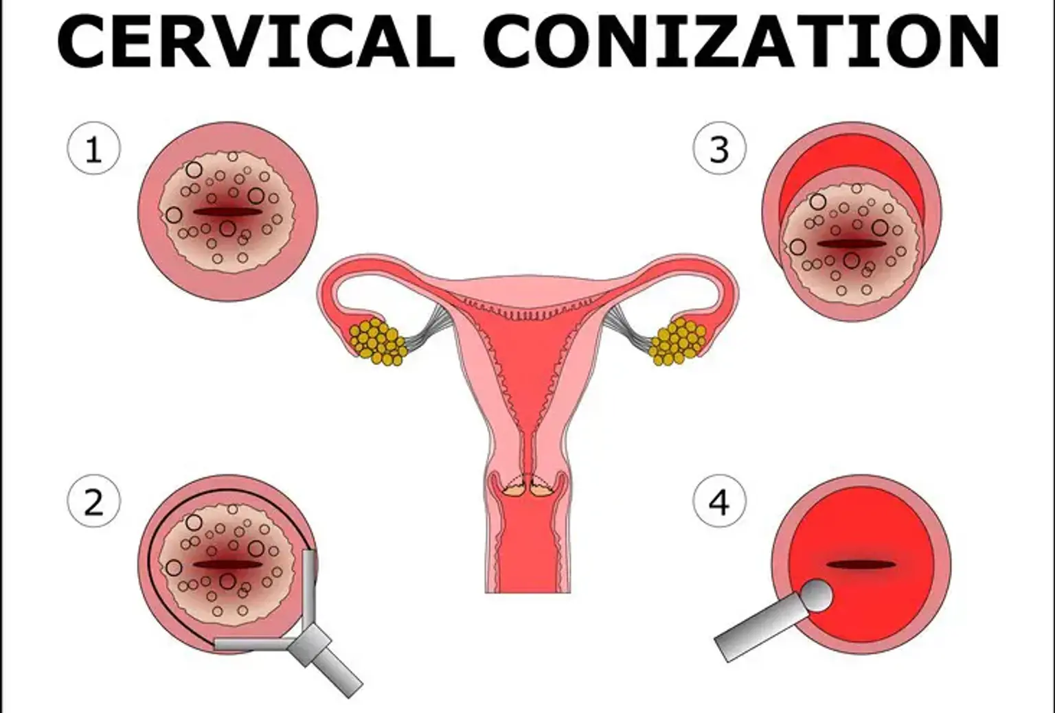 Cervix conization