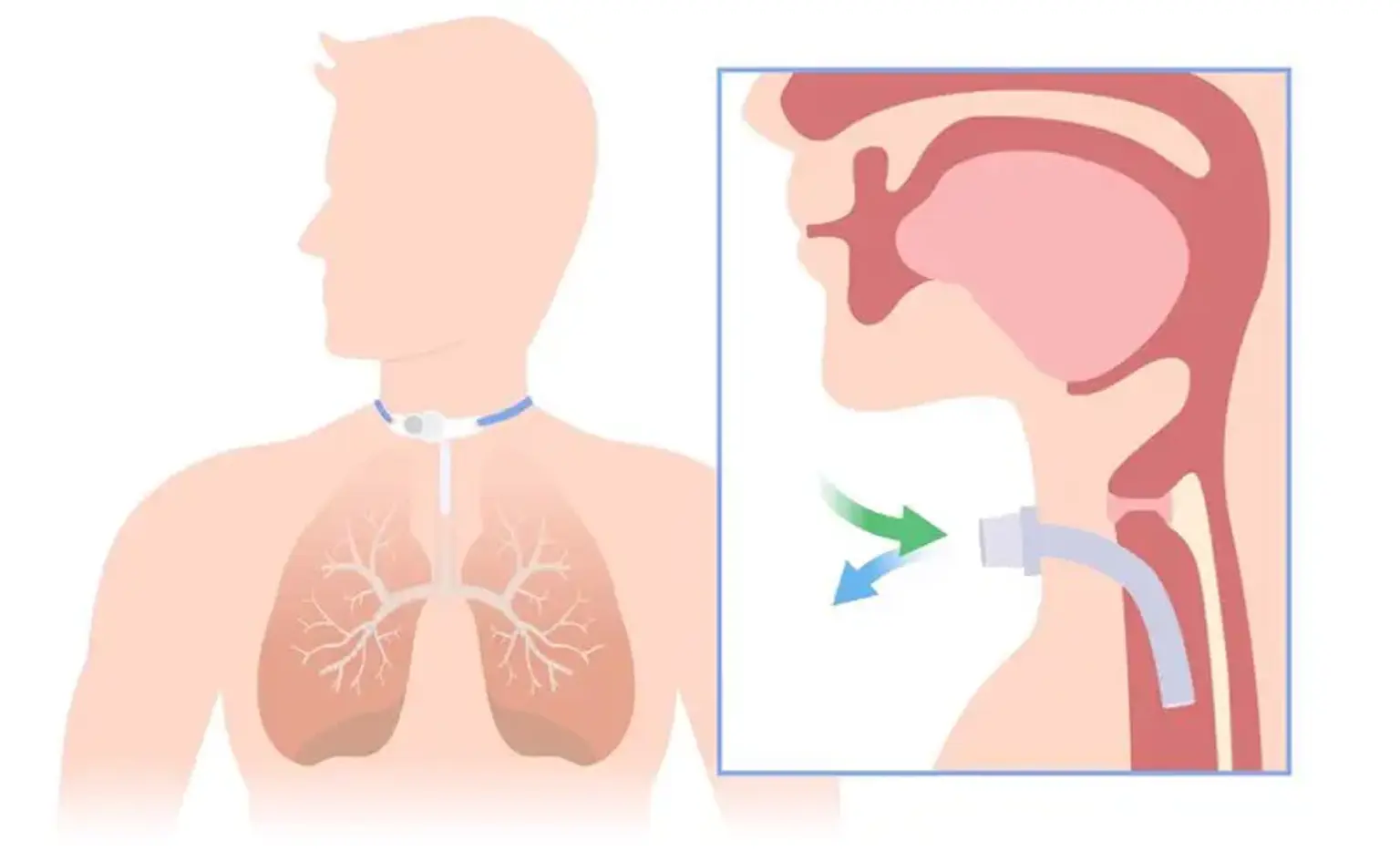 Tracheostomy Definition