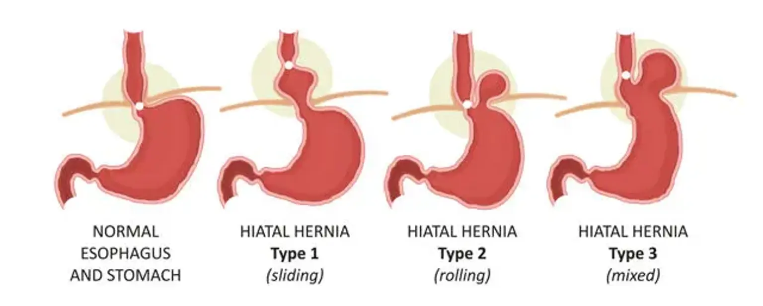 Hiatal hernia types