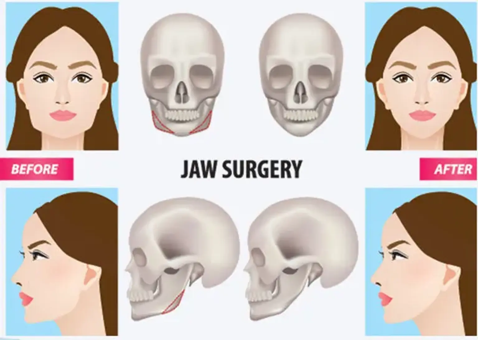 Jaw correction surgery