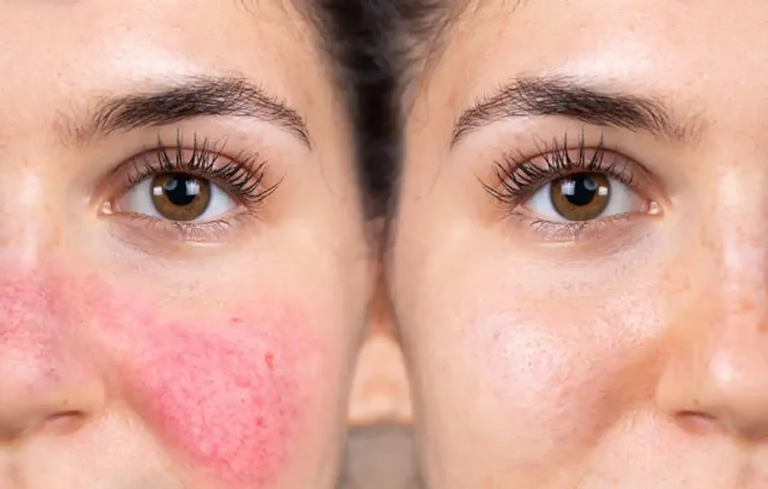 Liable to get Rosacea