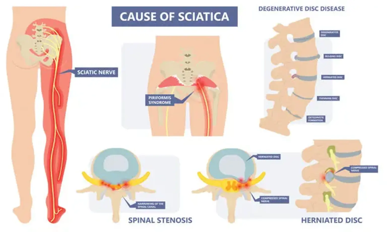 Causes of sciatica