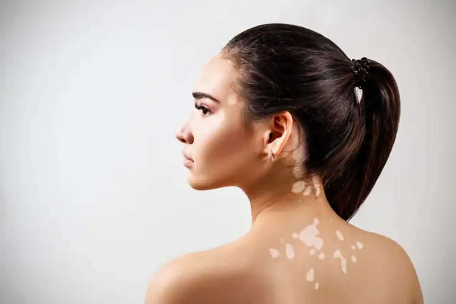 Signs and Symptoms of Vitiligo