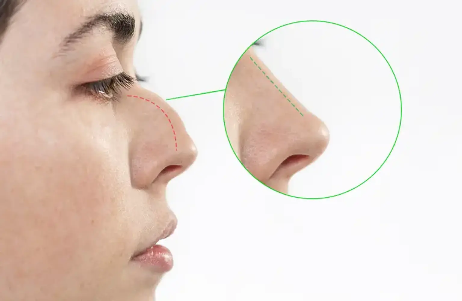 curved nose procedure