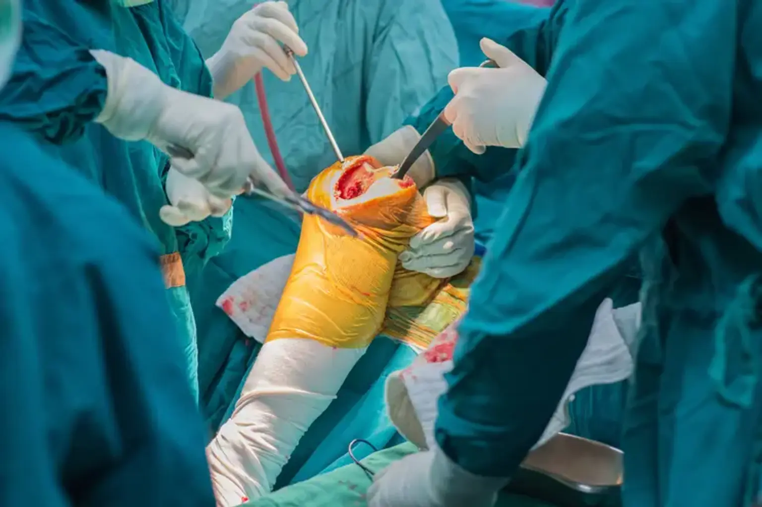 Knee osteotomy