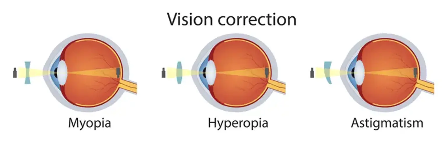 Astigmatism & Myopia