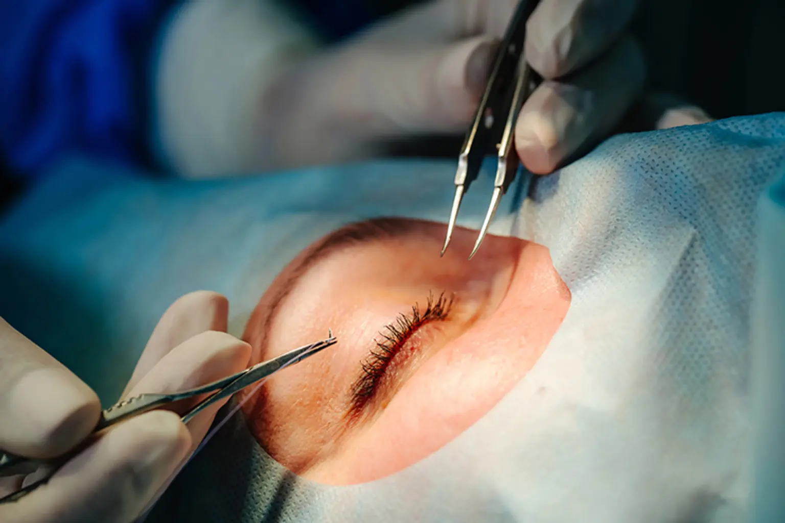 Phẫu thuật LASIK
