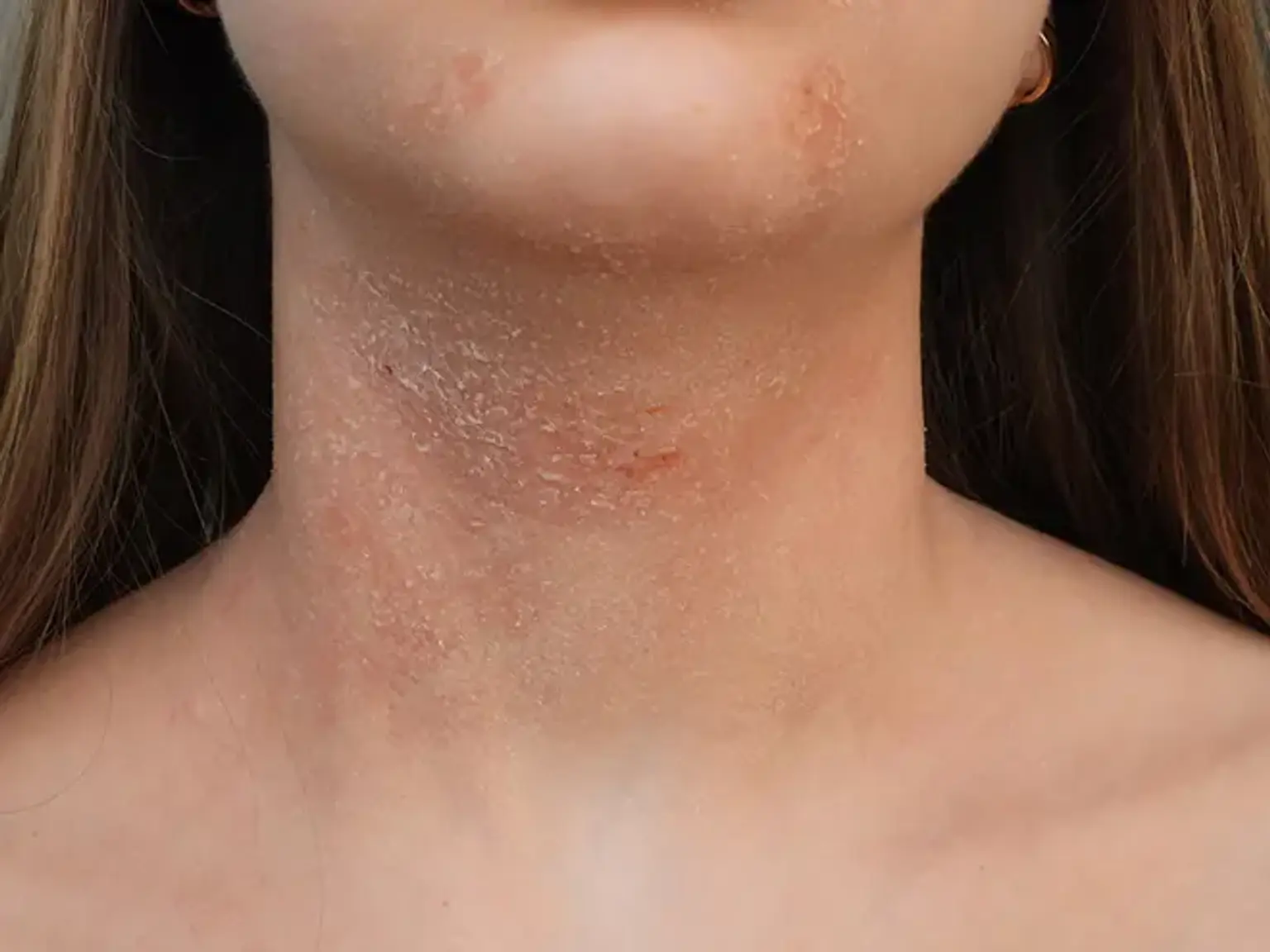 atopic dermatitis services