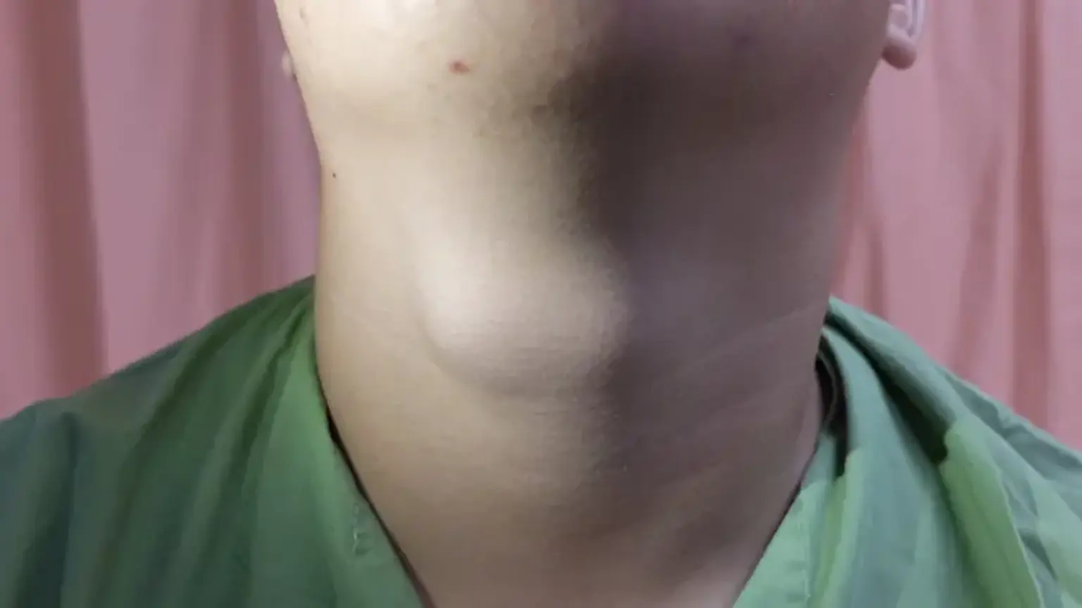 thyroglossal duct cyst?