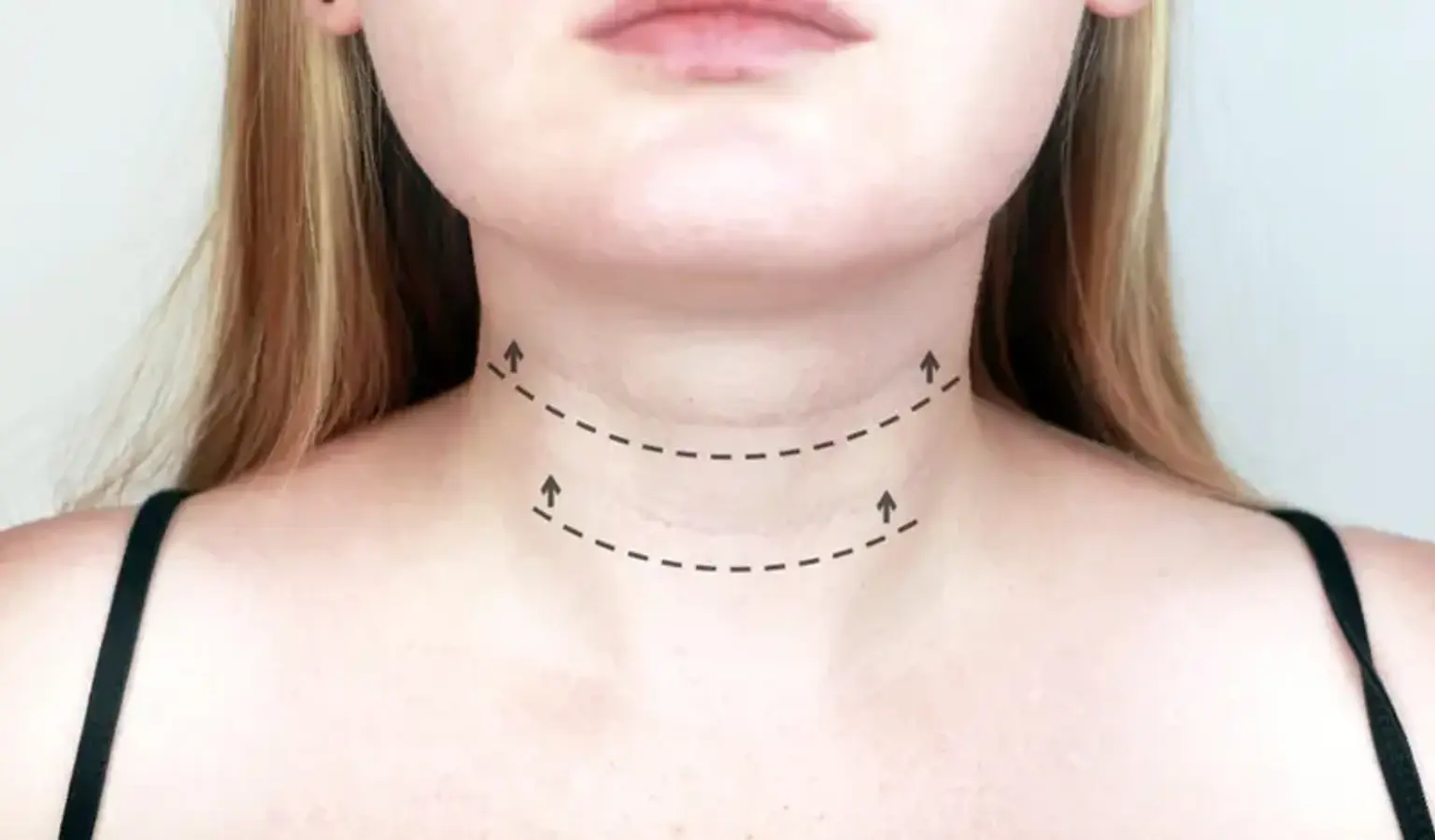 Straight neck lifts
