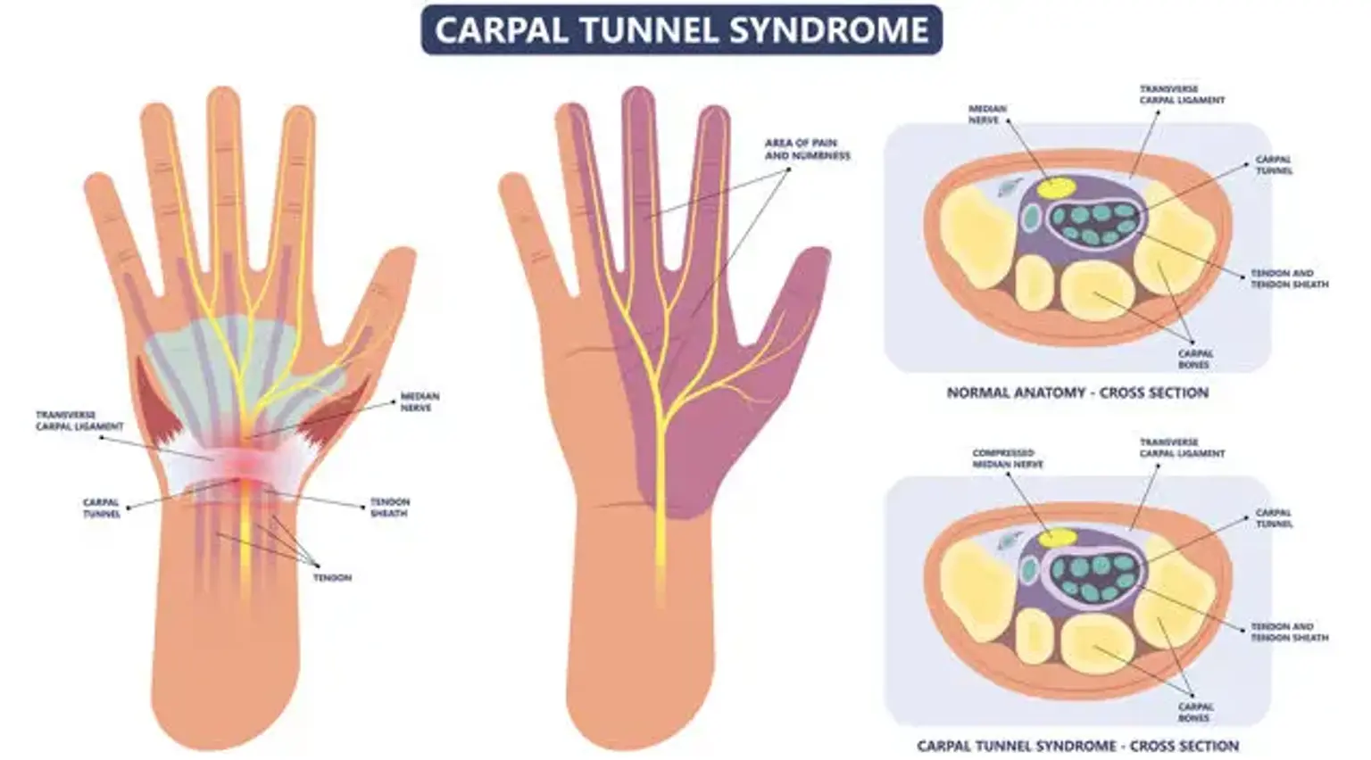 Carpal tunnel syndrome