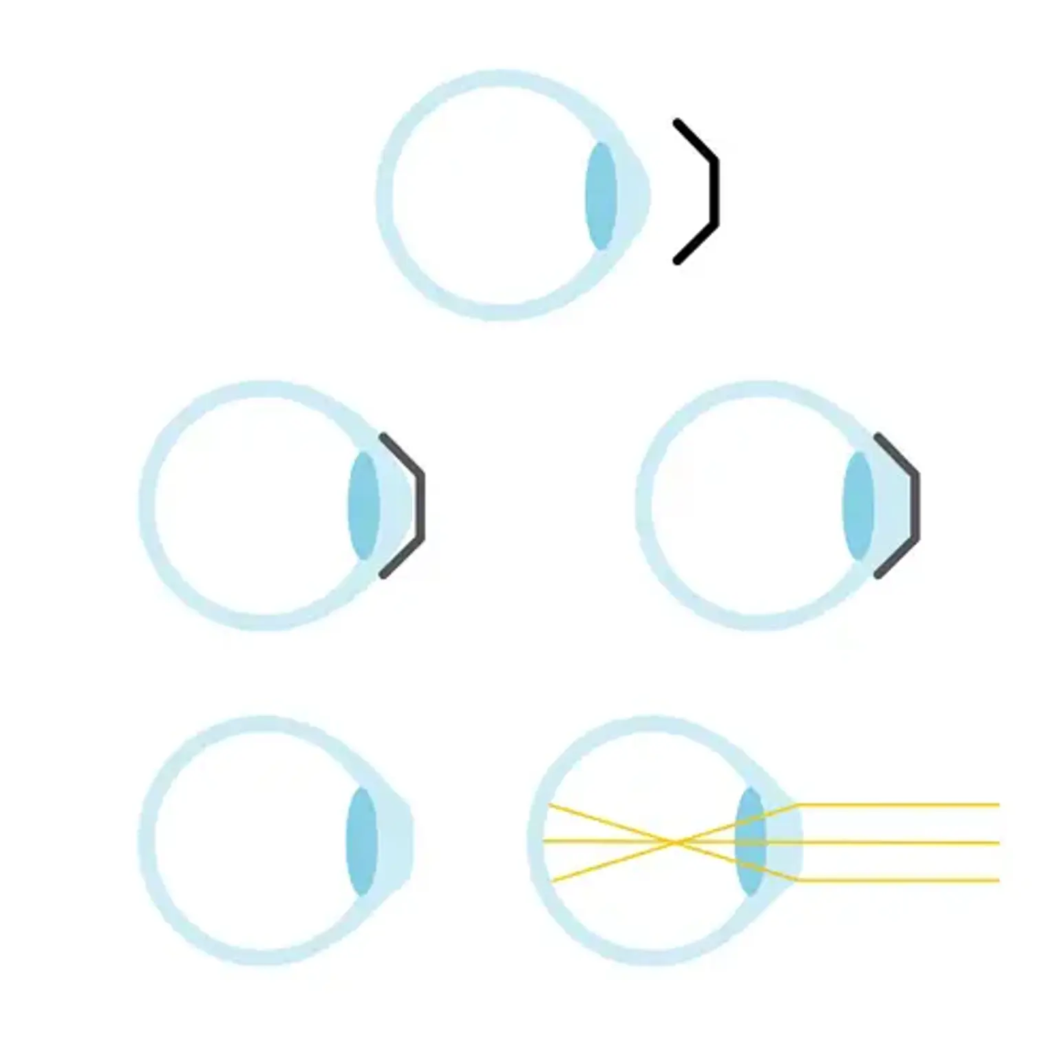 How Ortho-K Lens work?