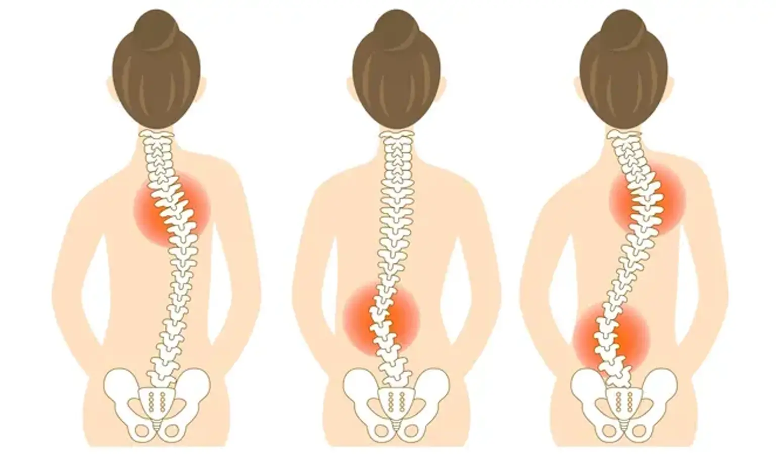 Types of Scoliosis