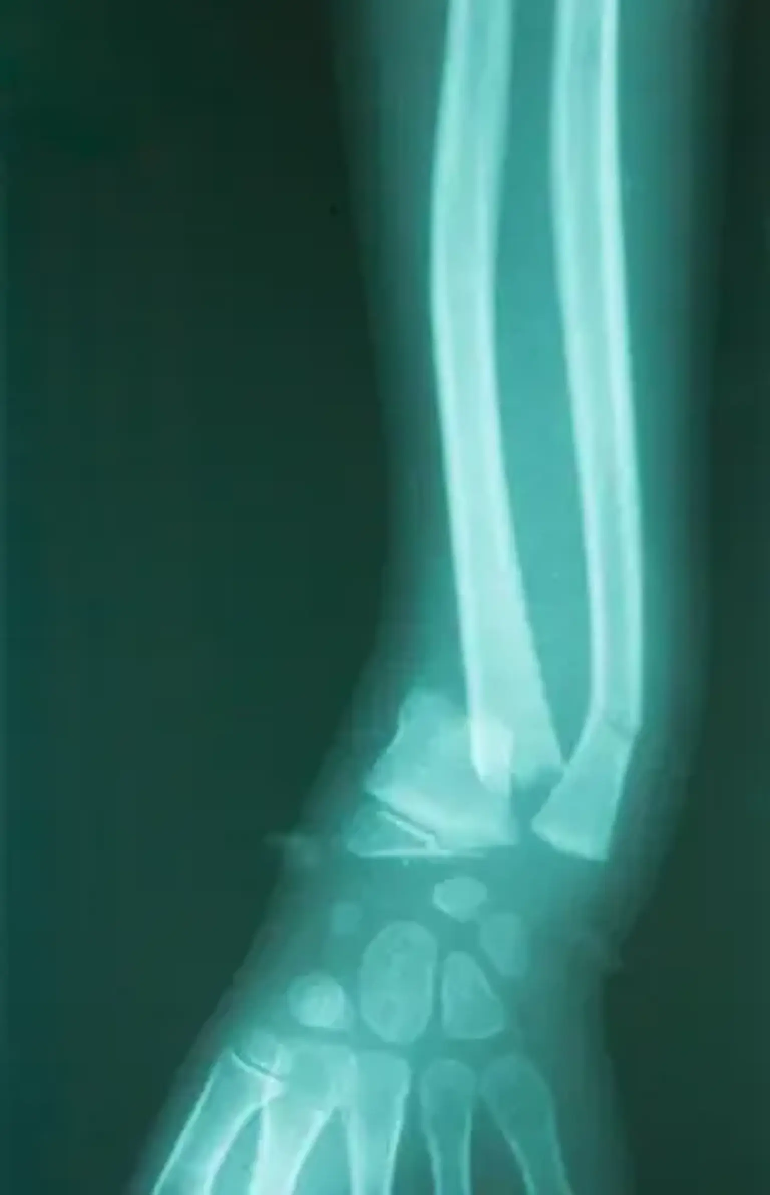 Pediatric Fractures