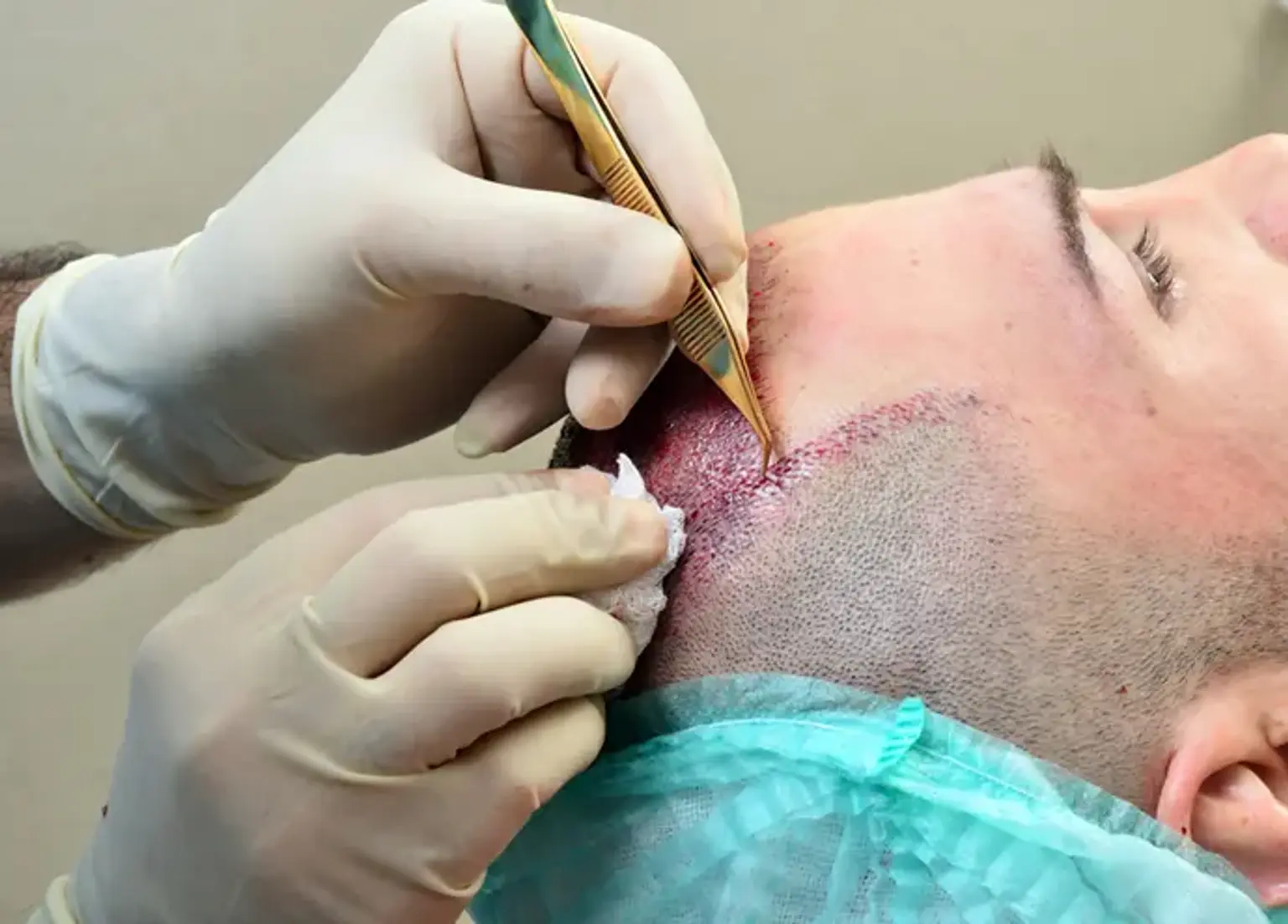 Turkish hair transplant clinic