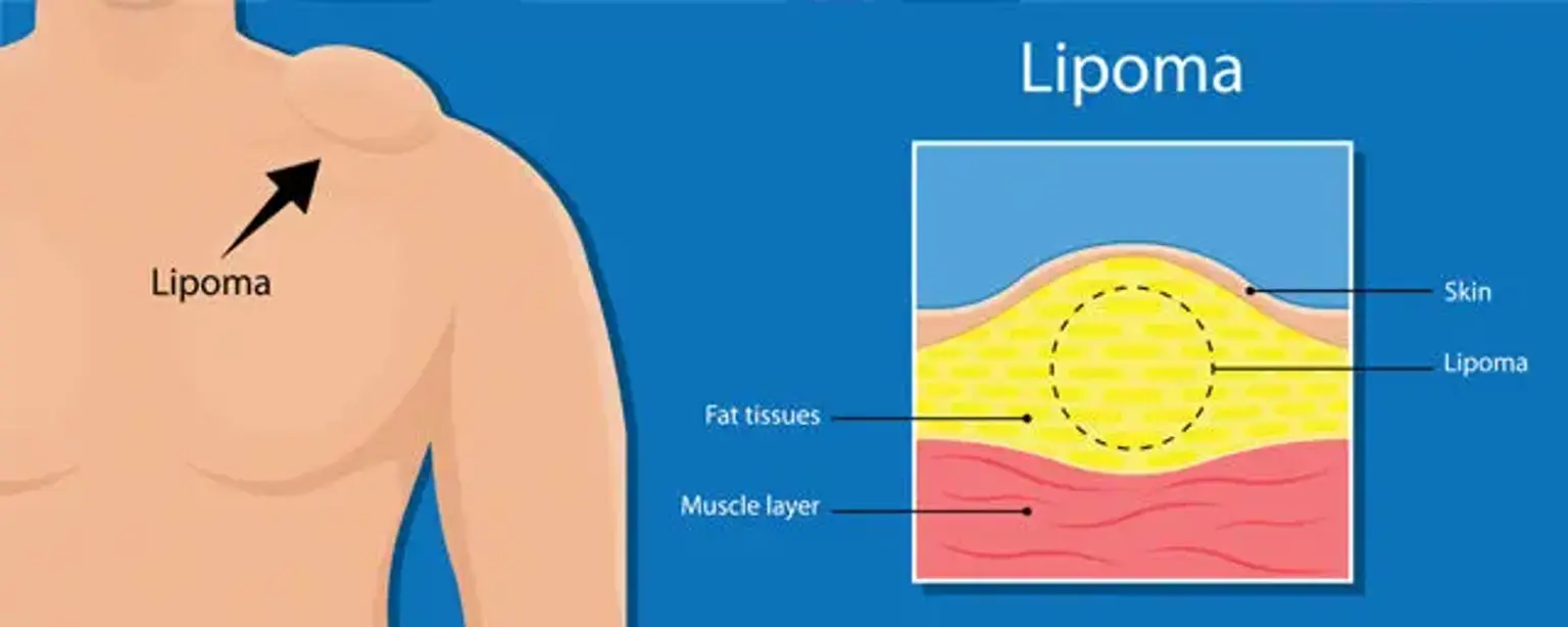 Type of Soft Tissue Tumors