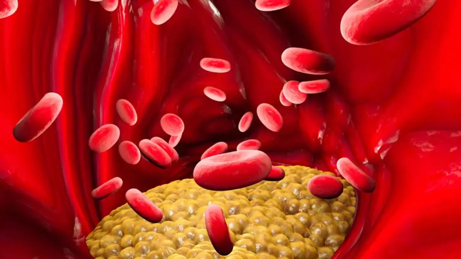 Bad cholesterol - LDL