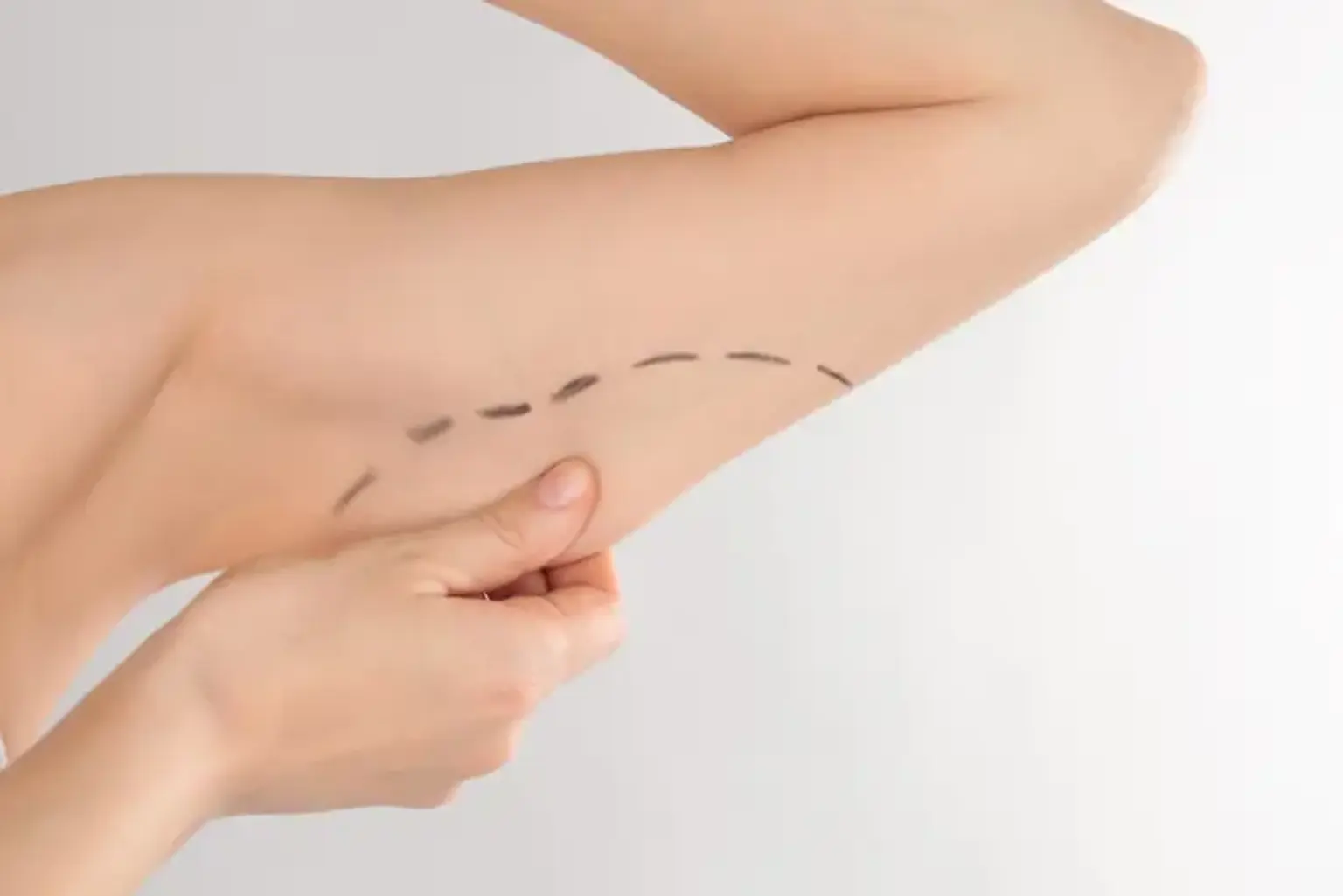 Benefits of Brachioplasty Surgery