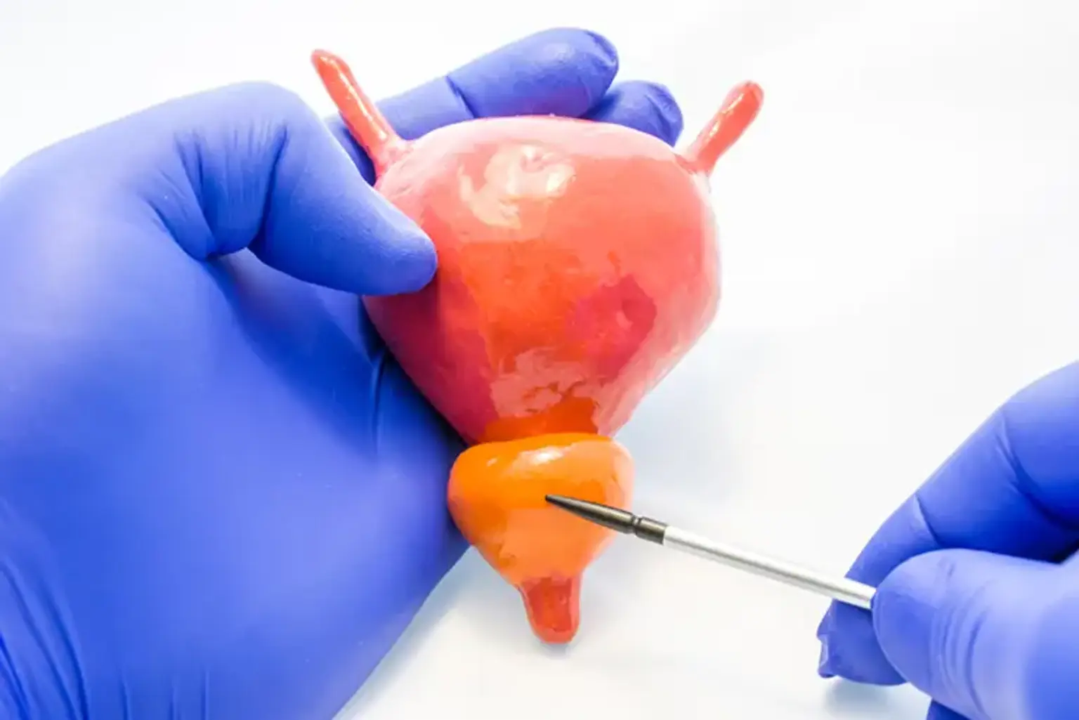 Robotic Prostatectomy (Da Vinci): Korea Patient Guide