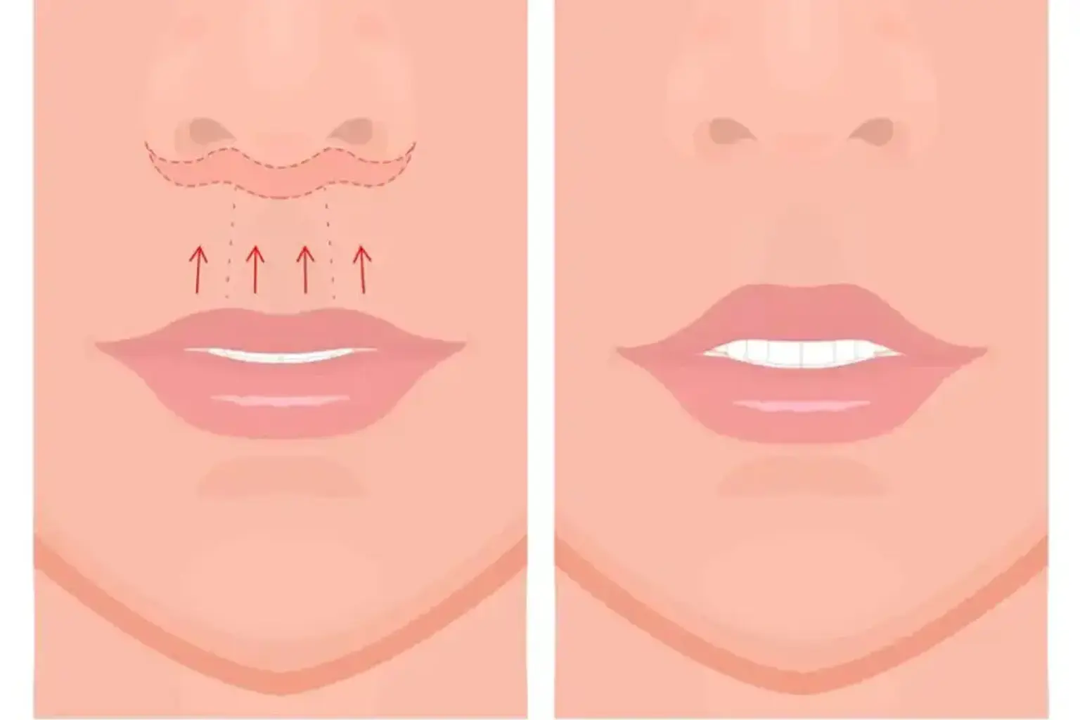 how-does-a-lip-lift-procedure-work