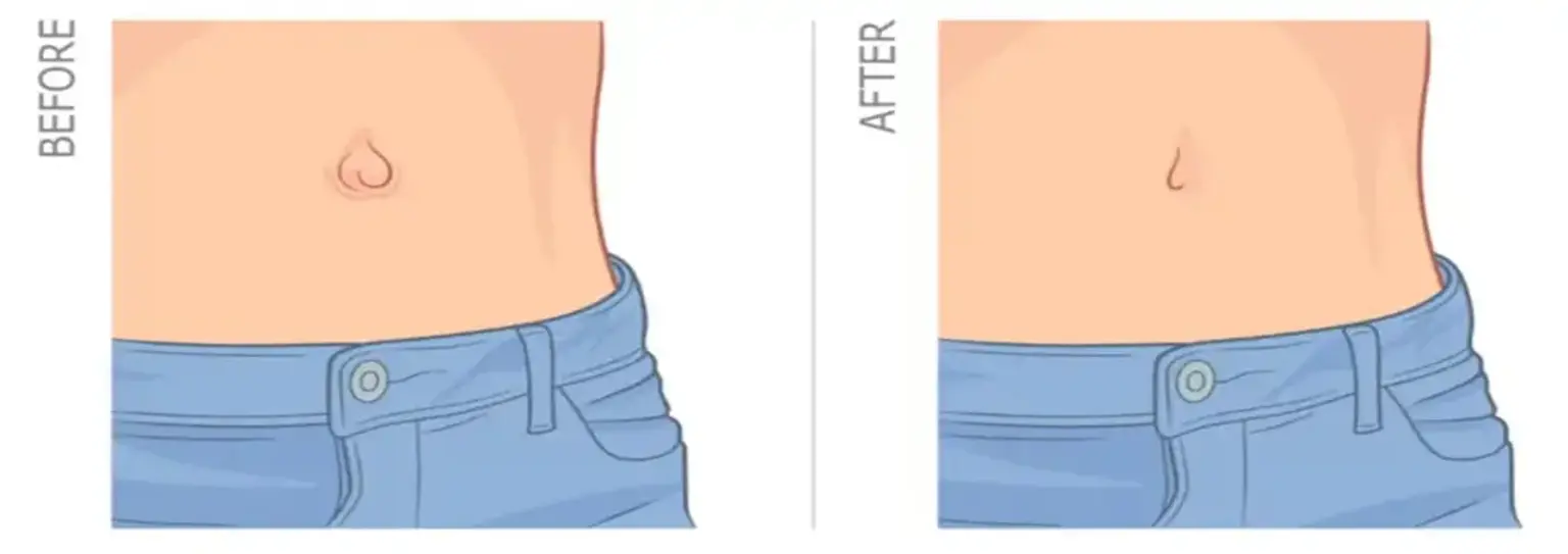 Ombligoplastía, image size:1536x543