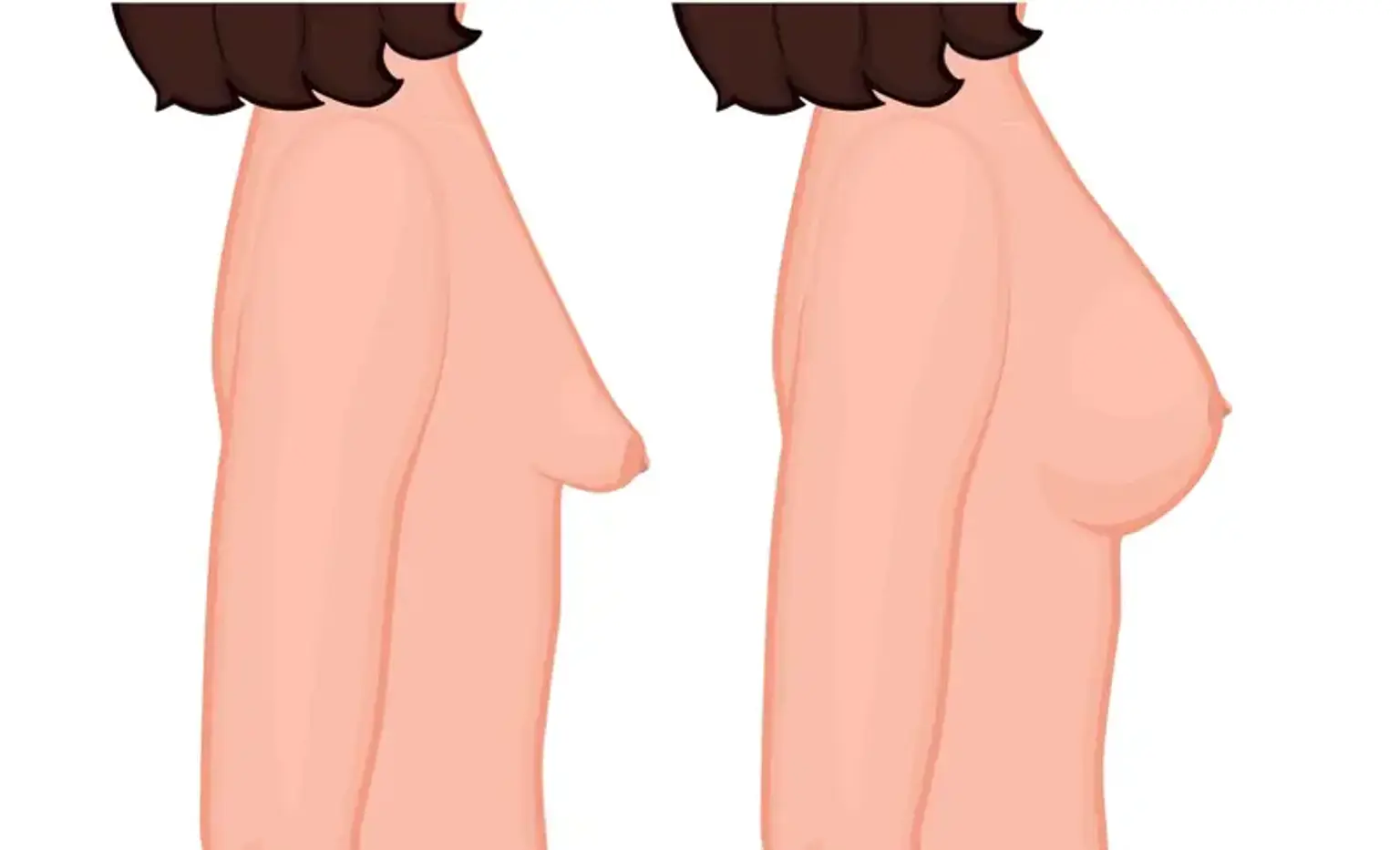 tuberous breast correction surgery