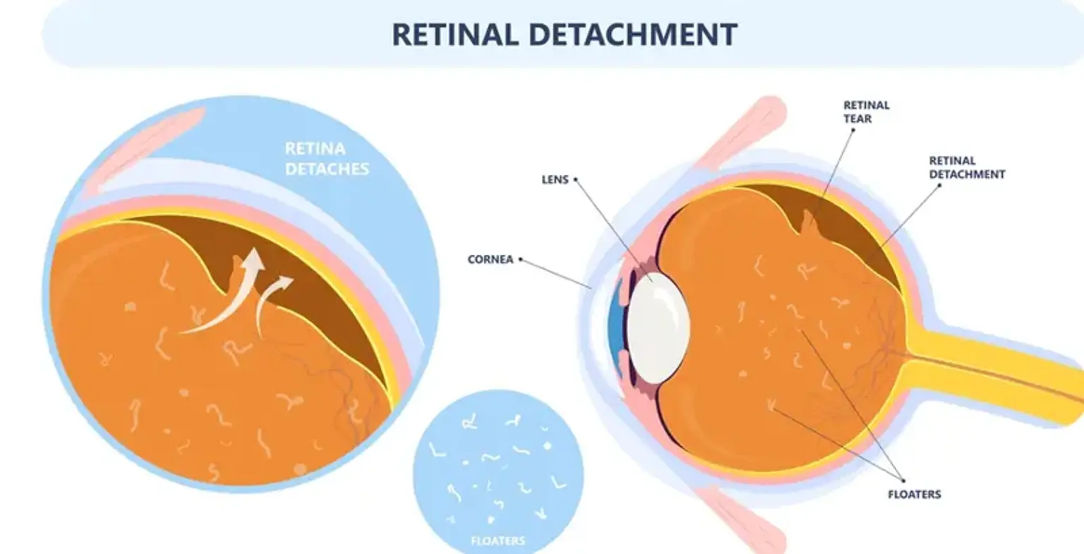 Retinal Detachment