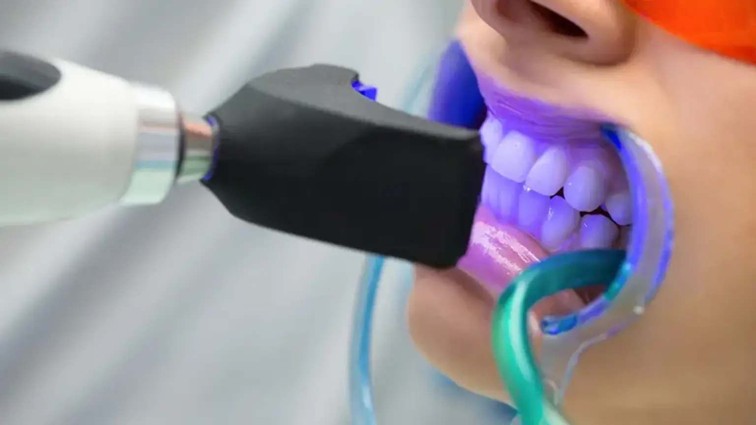 During Laser Teeth Whitening