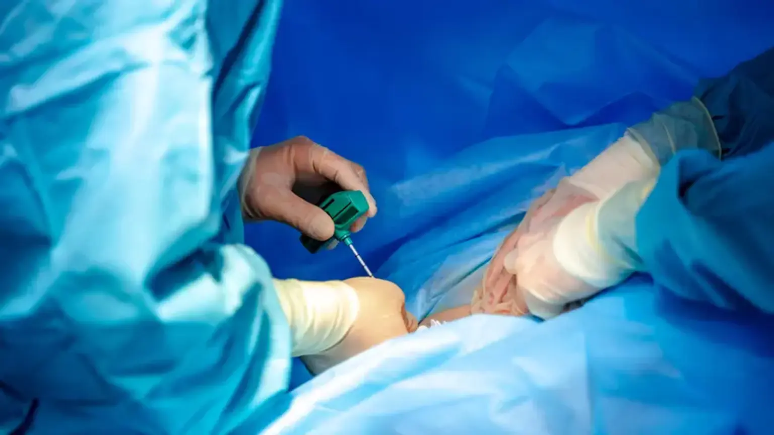 Allogeneic Hematopoietic Stem Cell Transplant 