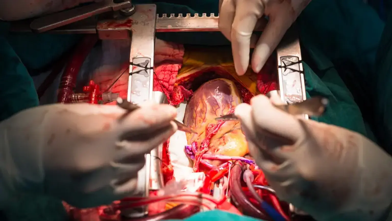 Coronary Artery Bypass Grafting 