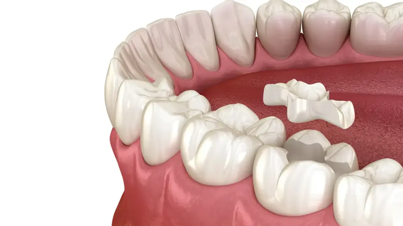 CEREC inlays and onlays