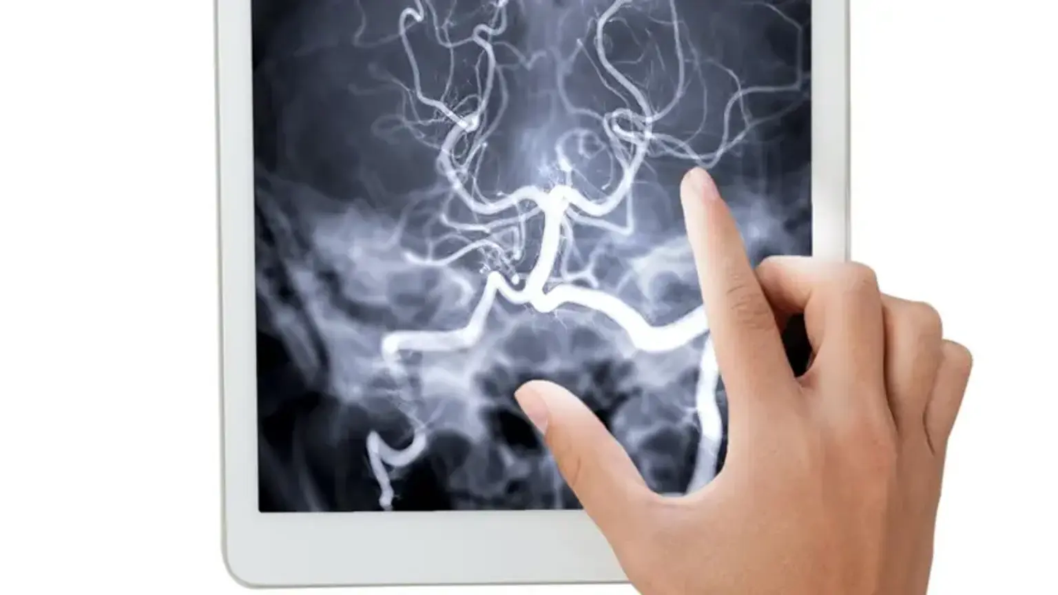 Endovascular Coiling