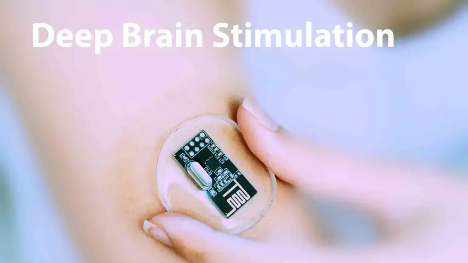 Deep Brain Stimulation