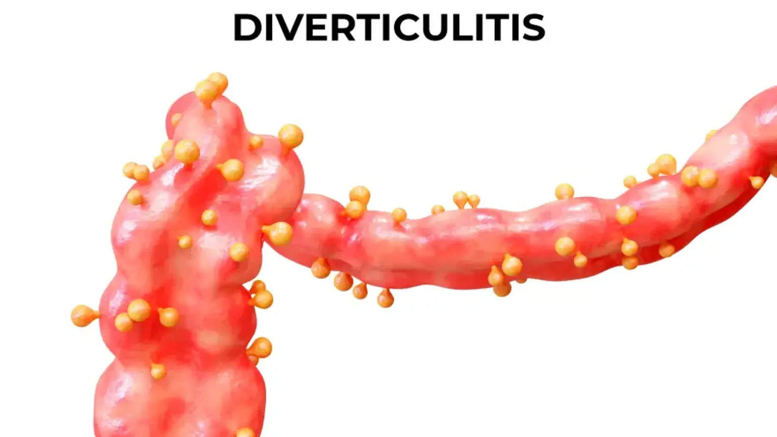 Diverticulitis Explained: A Complete Guide to Causes, Symptoms, and ...