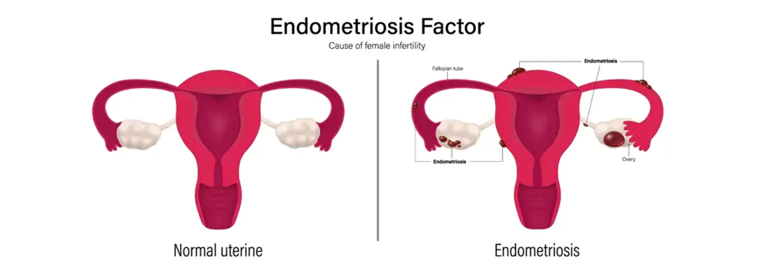 Endometriosis 