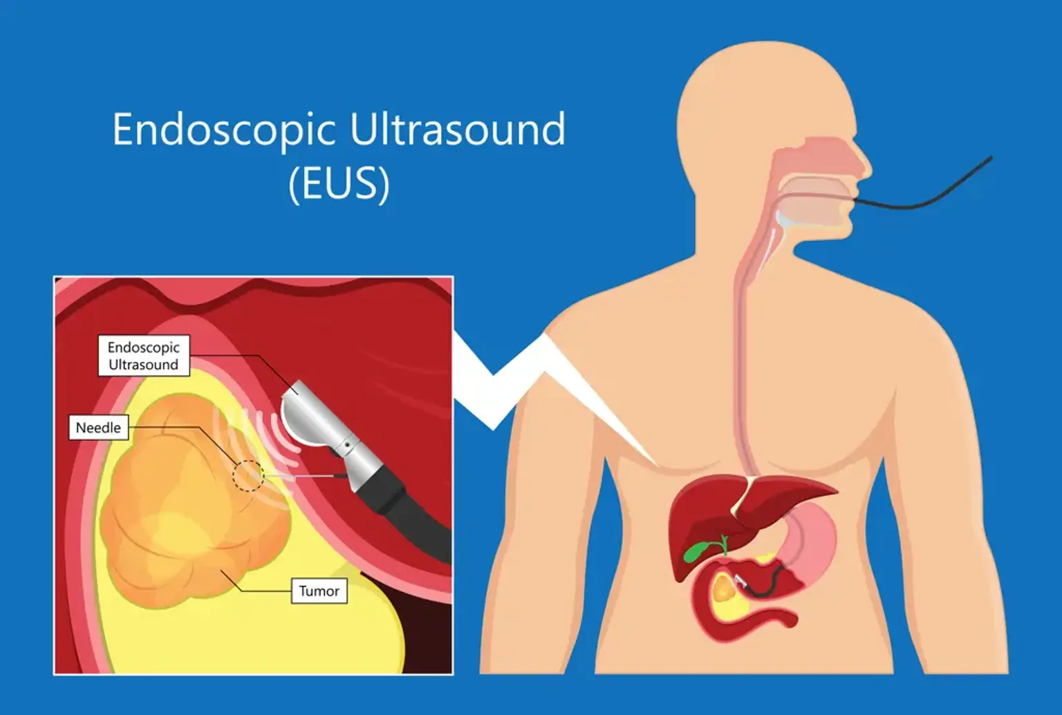 Endoscopic Pancreatic Necrosectomy