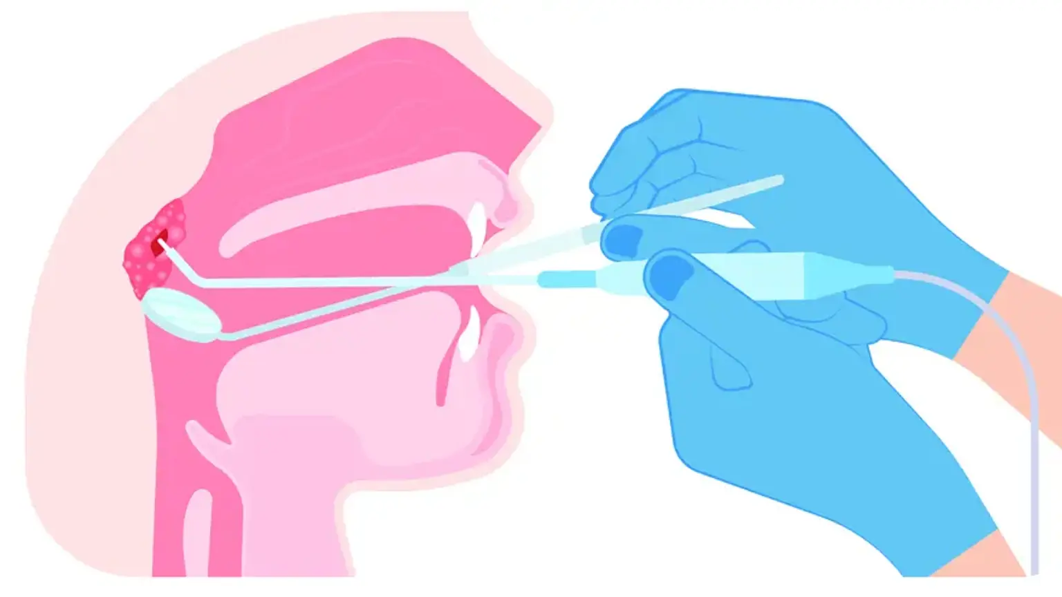 Endoscopic Transsphenoidal Pituitary Surgery