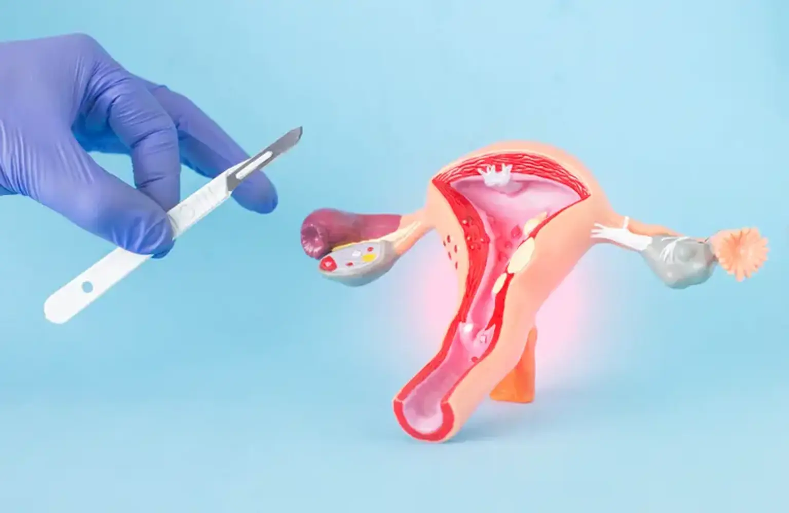 Myomectomy