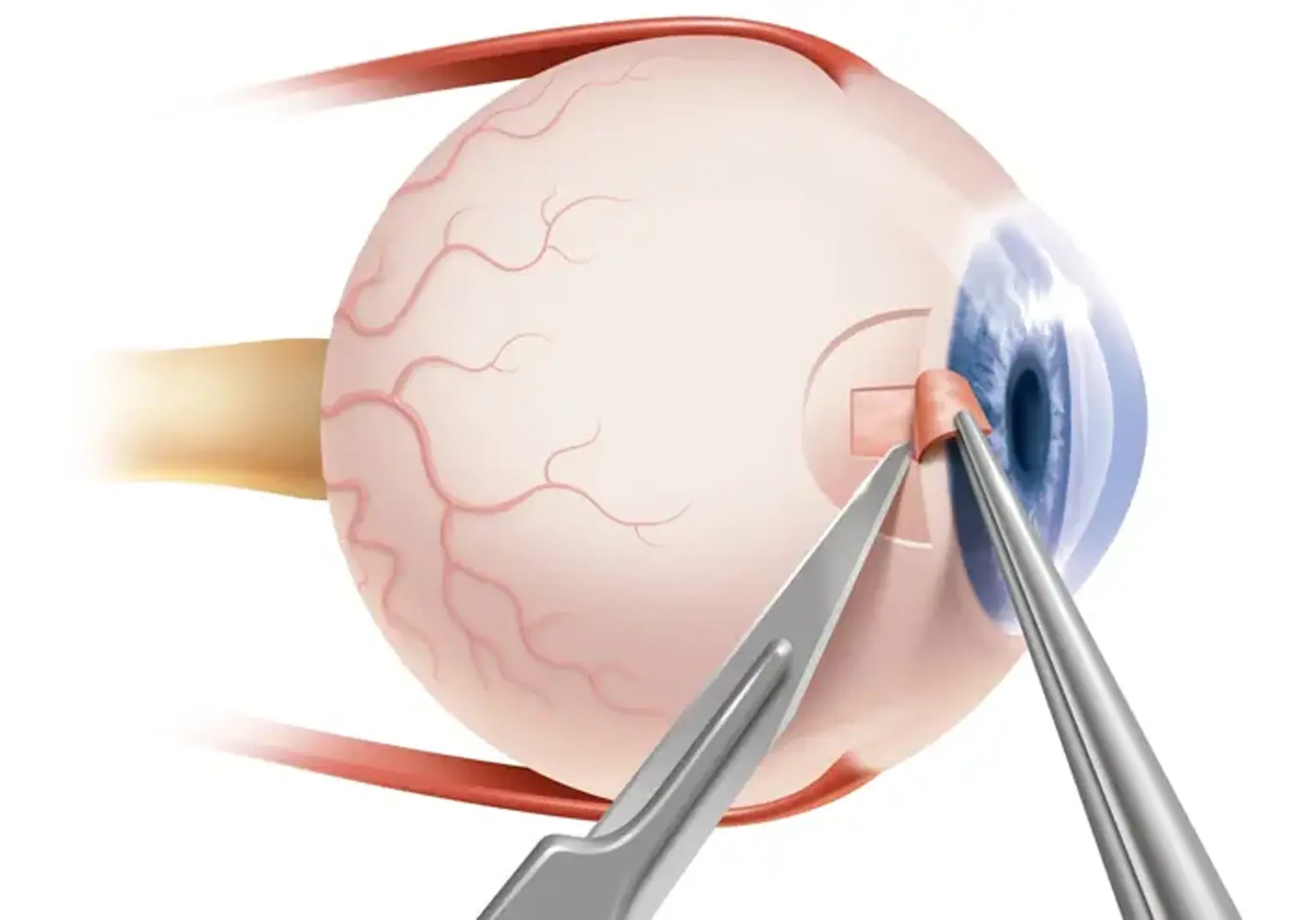Oculoplastic Surgery