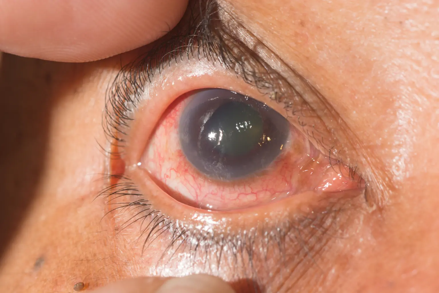 Atención al glaucoma